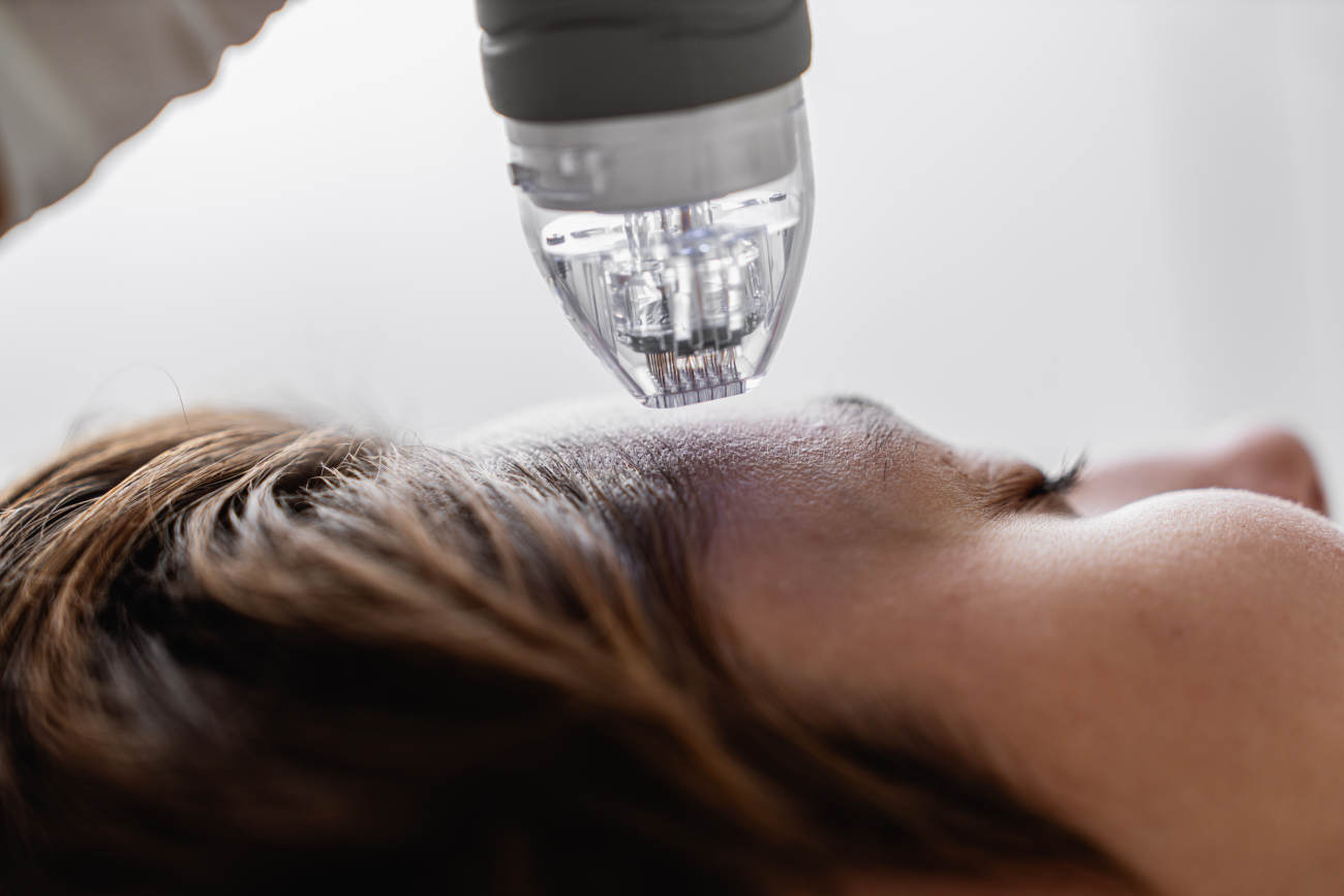 Microneedle RF lifting procedure. Hardware cosmetology. High quality photo